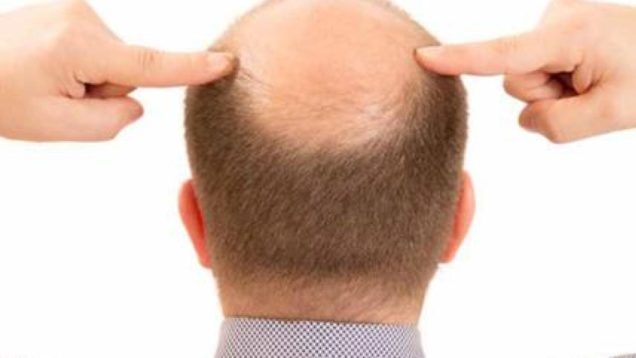 alopecia androgenetica