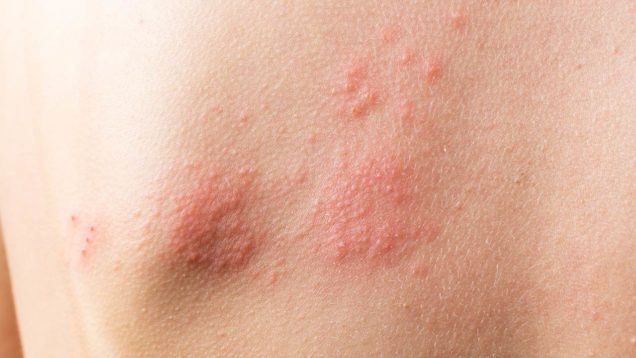 orticaria cronica spontanea