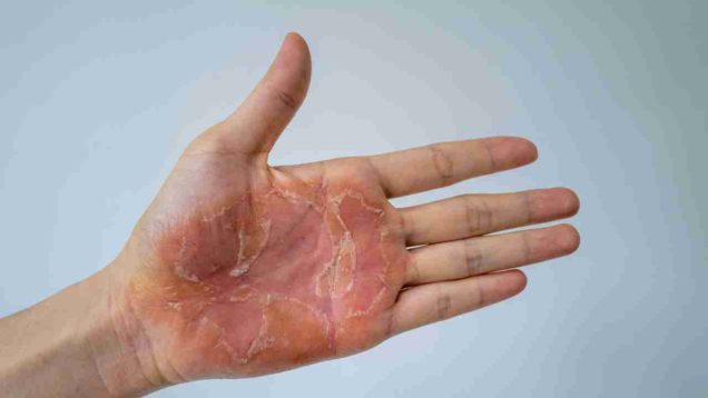 eczema cronico delle mani